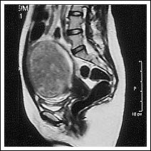 At 14th August 1998. MRI scan of pelvis showing large 12cm fibroid.