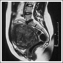 At 26th January 1998 - large 12cm full thickness fibroid.