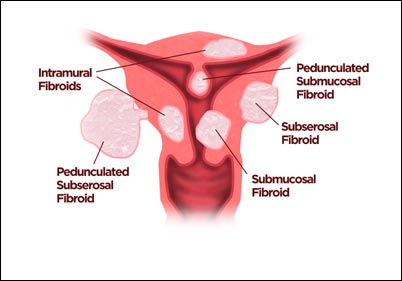 Uterine Fibroids